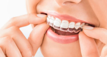 Role of Clear Aligners. 