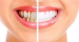 Fort Lauderdale Professional Teeth Whitening: Know What to Expect from It